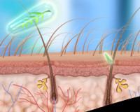 kıl kökü iltihabı tedavisi