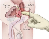 prostat büyümesinin belirtileri