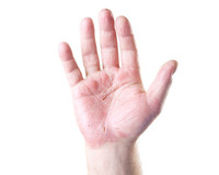 Sedef hastalığım var tedavi olmazsam ne olur? Sedef hastalığım var tedavi olmazsam ne olur?