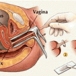 smear testi