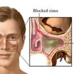 sinüzit tedavisi