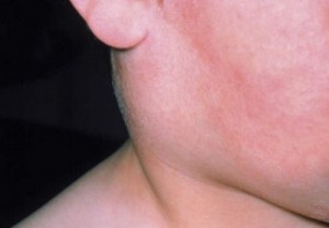 Ahmet Maranki tükürük bezi iltihabı tedavisi