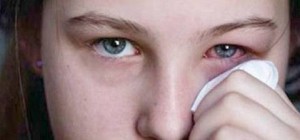 Çocuklarda gözaltı kızarıklığı