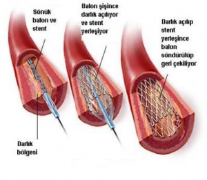 Böbreğe stent takılması