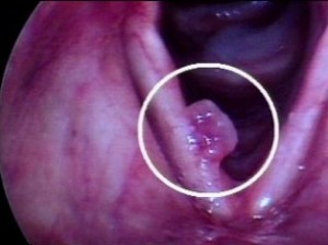 Gırtlak kisti nedir?