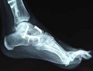 Ayak parmağı kemik çatlağı tedavisi