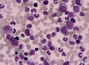 Kronik-Granülositik-Lösemi