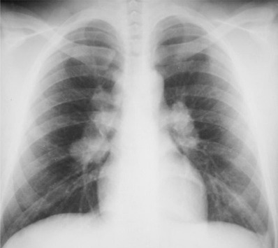 Ahmet Maranki Sarkoidoz Hastalığına Kür