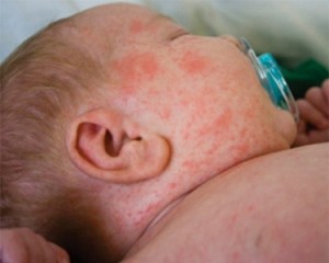 saglik-bakanligi-kizamik-hastaligi