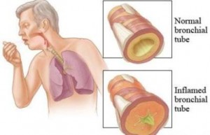 Bronşit Tedavi Edilmezse Ne Olur