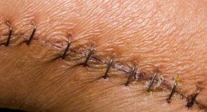 Stock Photo of Surgical Scar
