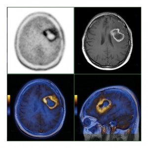 Beyin Tümörlerinde PET / CT Nasıl Kullanılır?