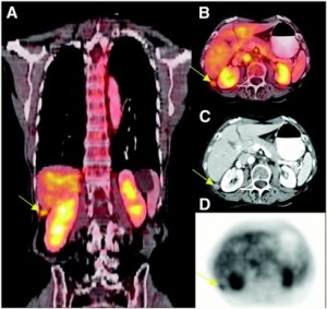 PET CT'nin Yararları Nelerdir