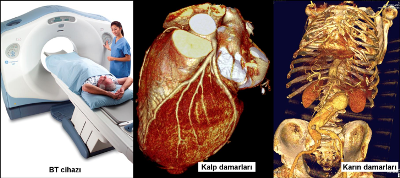 Kardiyak  Koroner BT Anjiyografi Kimlere Yapılmalıdır