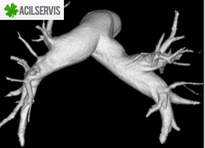 Kardiyak-Koroner-BT-Anjiyografi-Islemi-Nasil-Yapilir