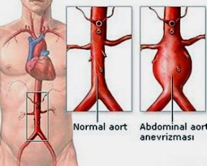 abdominal-aort