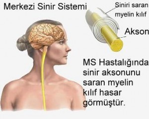 ms-hastaligi