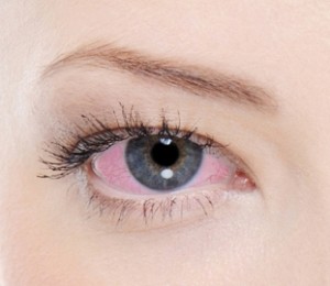 Göz kanlanması nedenleri