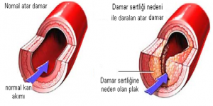 Damar sertliği tedavisi