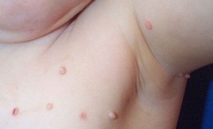 Siğil tedavisi için tek seansta çözüm