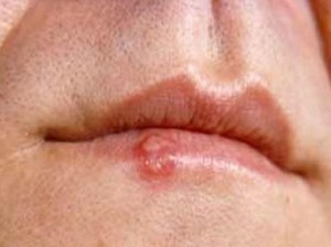 Uçuk bitkisel tedavisi