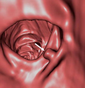 Sanal kolonoskopi nasıl uygulanır?
