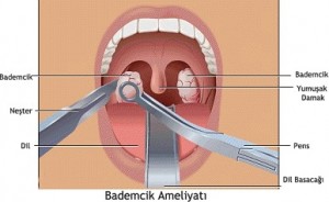 Bademcik ameliyatları tehlikeli mi? 