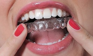 Ortodontik tedavi Fiyatlar? 2015