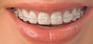 Diş teli tedavisini SGK karşılıyor mu?