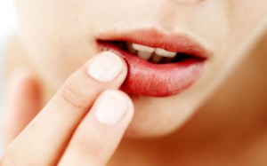 uçuk-nedir-nasıl-geçer