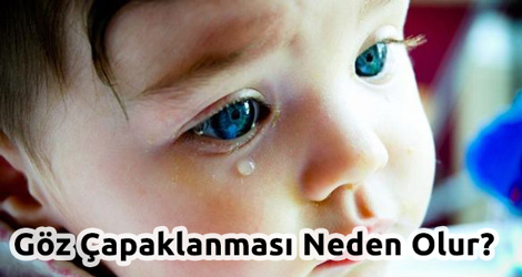 Göz Çapaklanmasına Ne İyi Gelir?