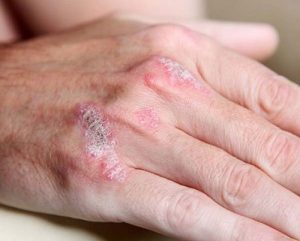 sedef-hastaliginin-tedavi-ile-gecmesi-mumkun