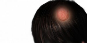 sac-kiran-neden-olur