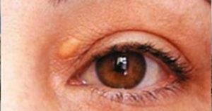 yag-bezesi-neden-olur