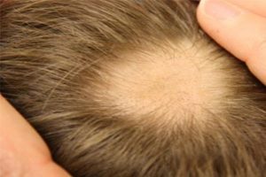 sackiran-tedavisi-nasil-yapilir