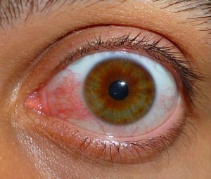 Gözde Kızarıklık Neden Olur?
