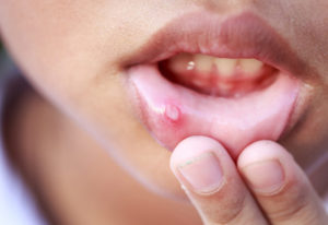 Ağızdaki Beyaz Yaralar Nasıl Geçer?
