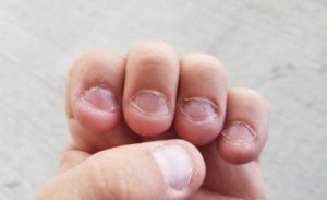 Tırnak Yeme Alışkanlığından Kurtulma