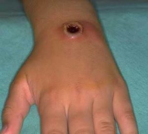 Şarbon Hastalığı Nedir, Belirtileri Nelerdir?